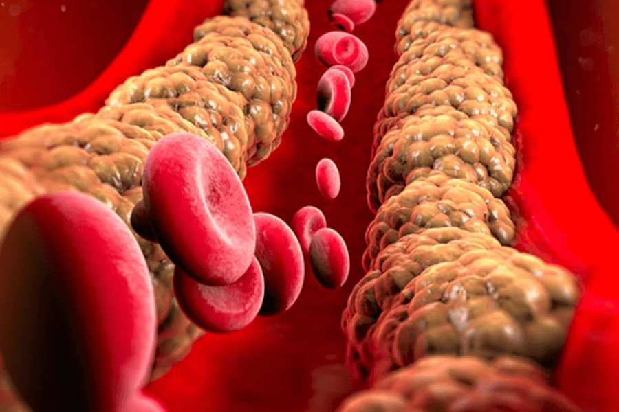 The Complete Overview of High Cholesterol
