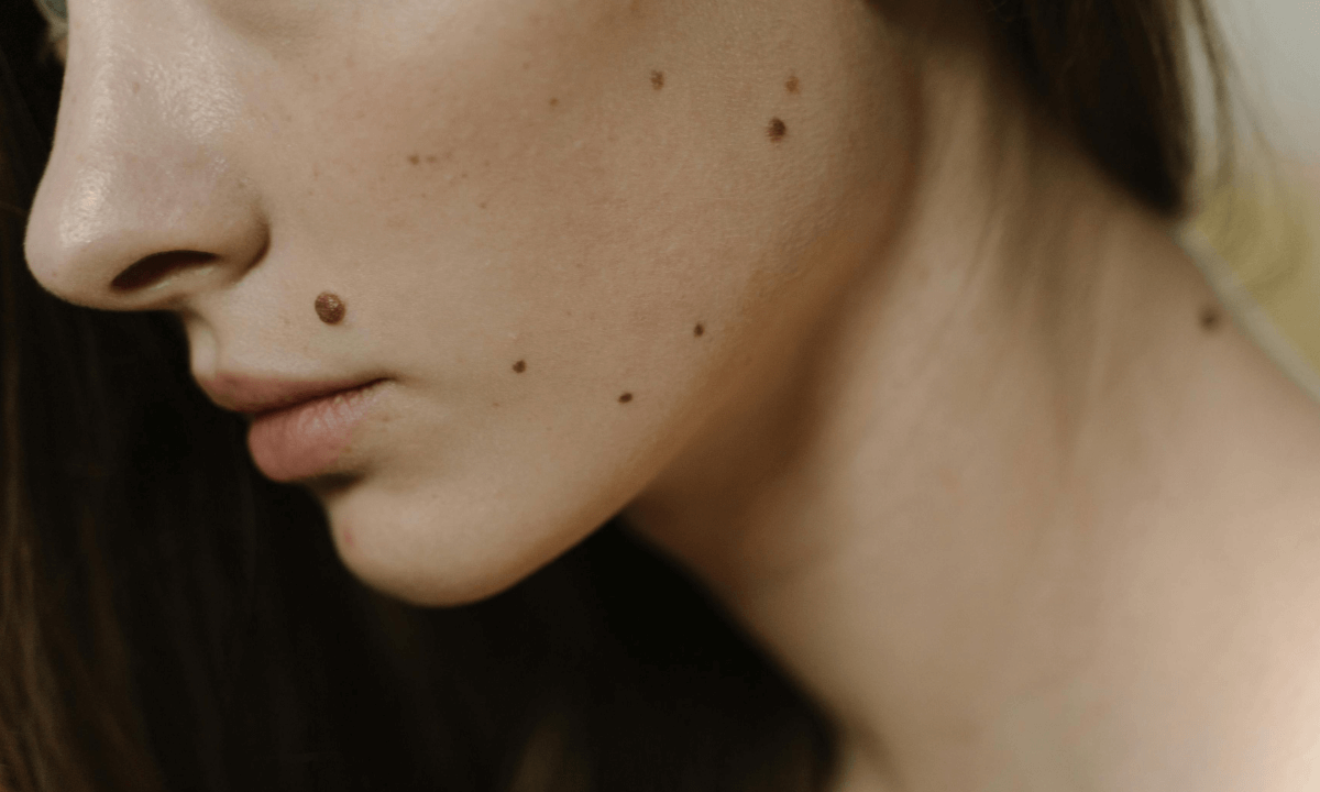 Beauty Mark vs Mole: What’s the Difference?
