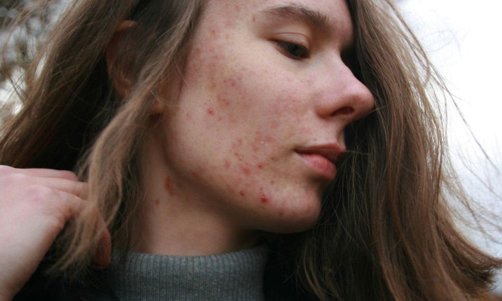 How To Get Rid of Acne Fast