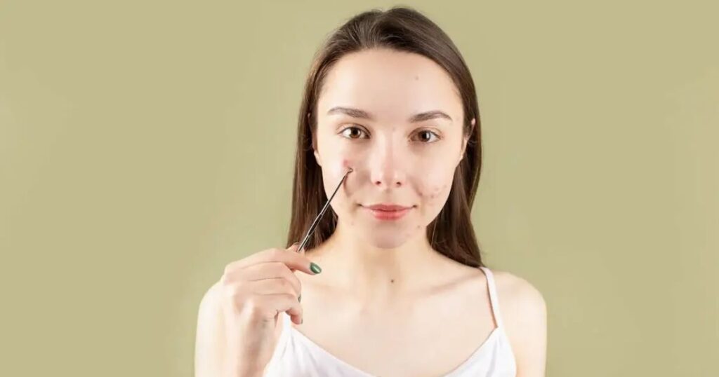 how to remove a blackhead that won't come out