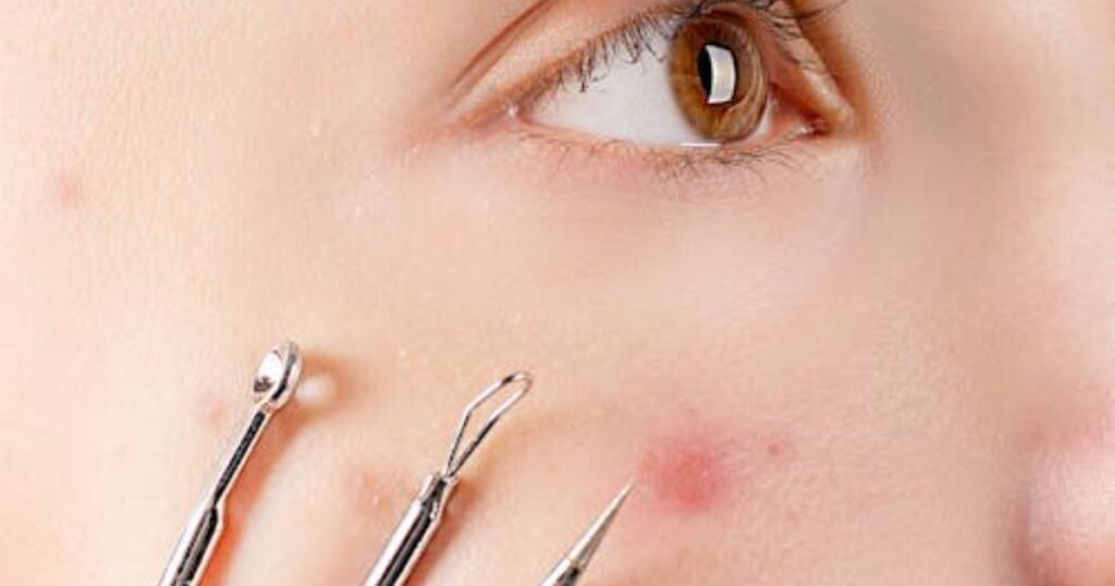 How to Remove a Blackhead That Won’t Come Out