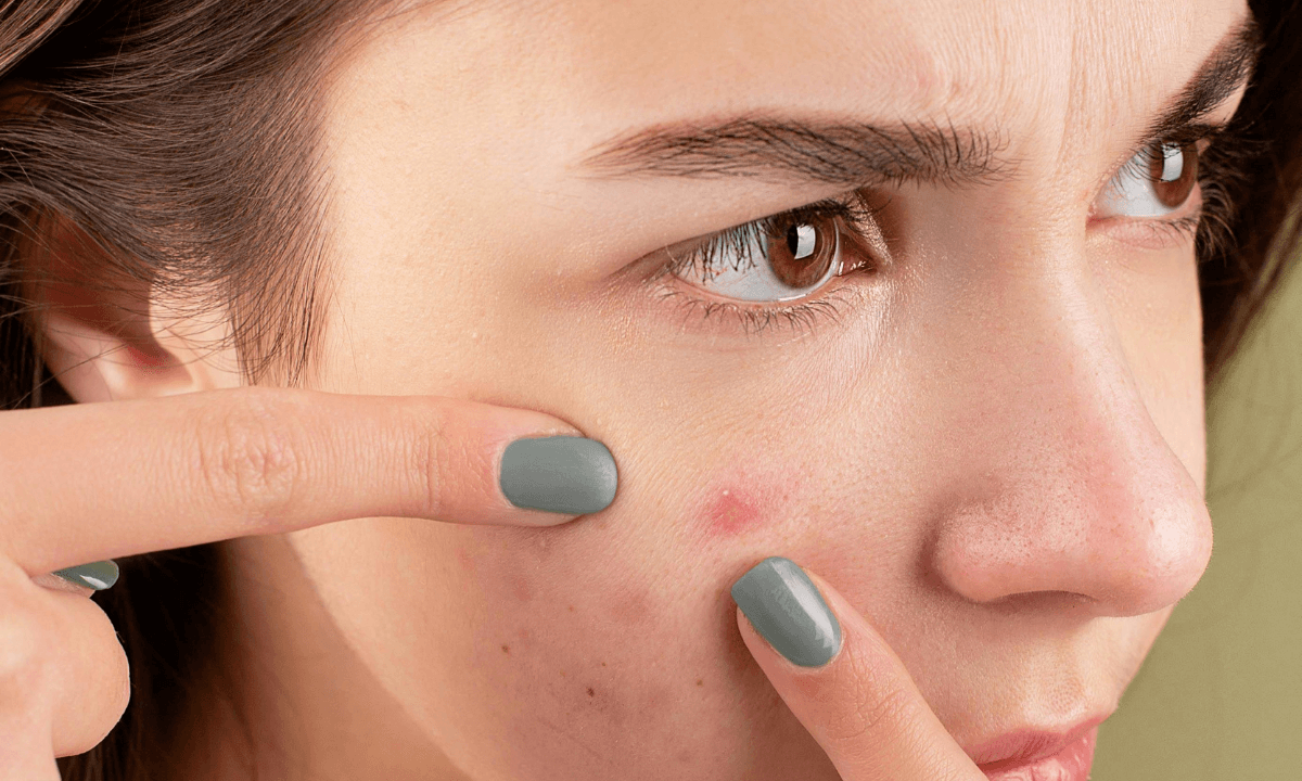 How to Get Rid of a Pimple in 5 Minutes?
