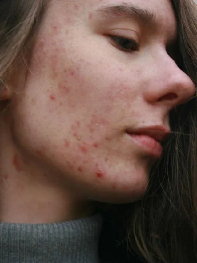 How To Get Rid of Acne Fast at Home Naturally?