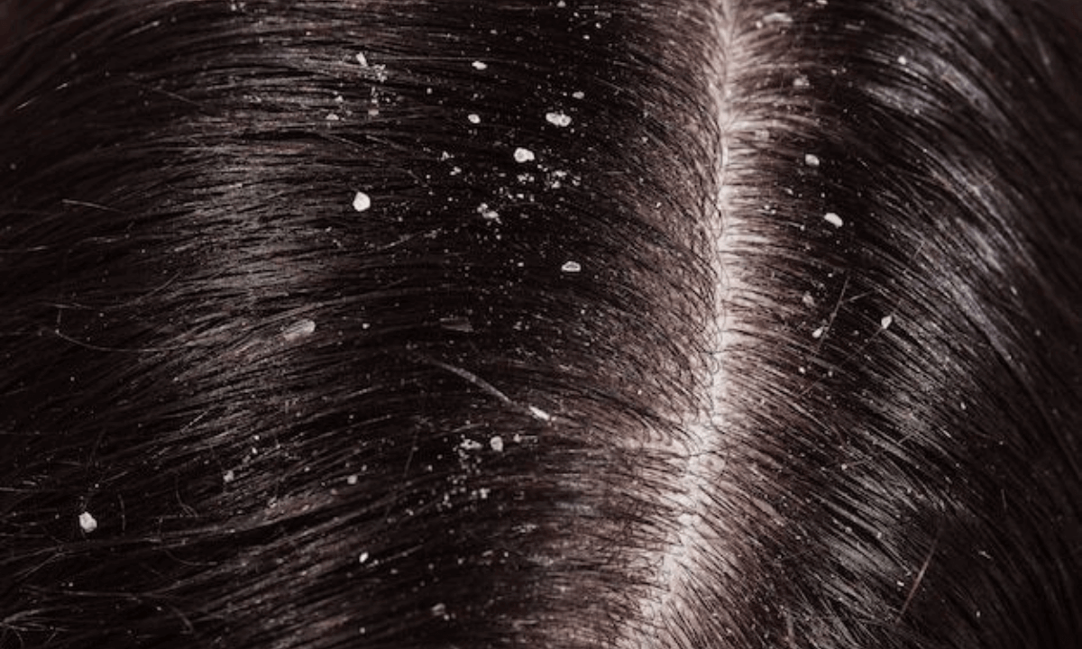 How to Get Rid of Dandruff Permanently?